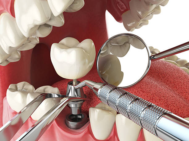 Best Emergency Dentist for Lost Fillings or Crowns in Vander, NC